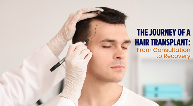 The Journey of a Hair Transplant: From Consultation to Recovery by Assure Clinic - Journey of a Hair Transplant